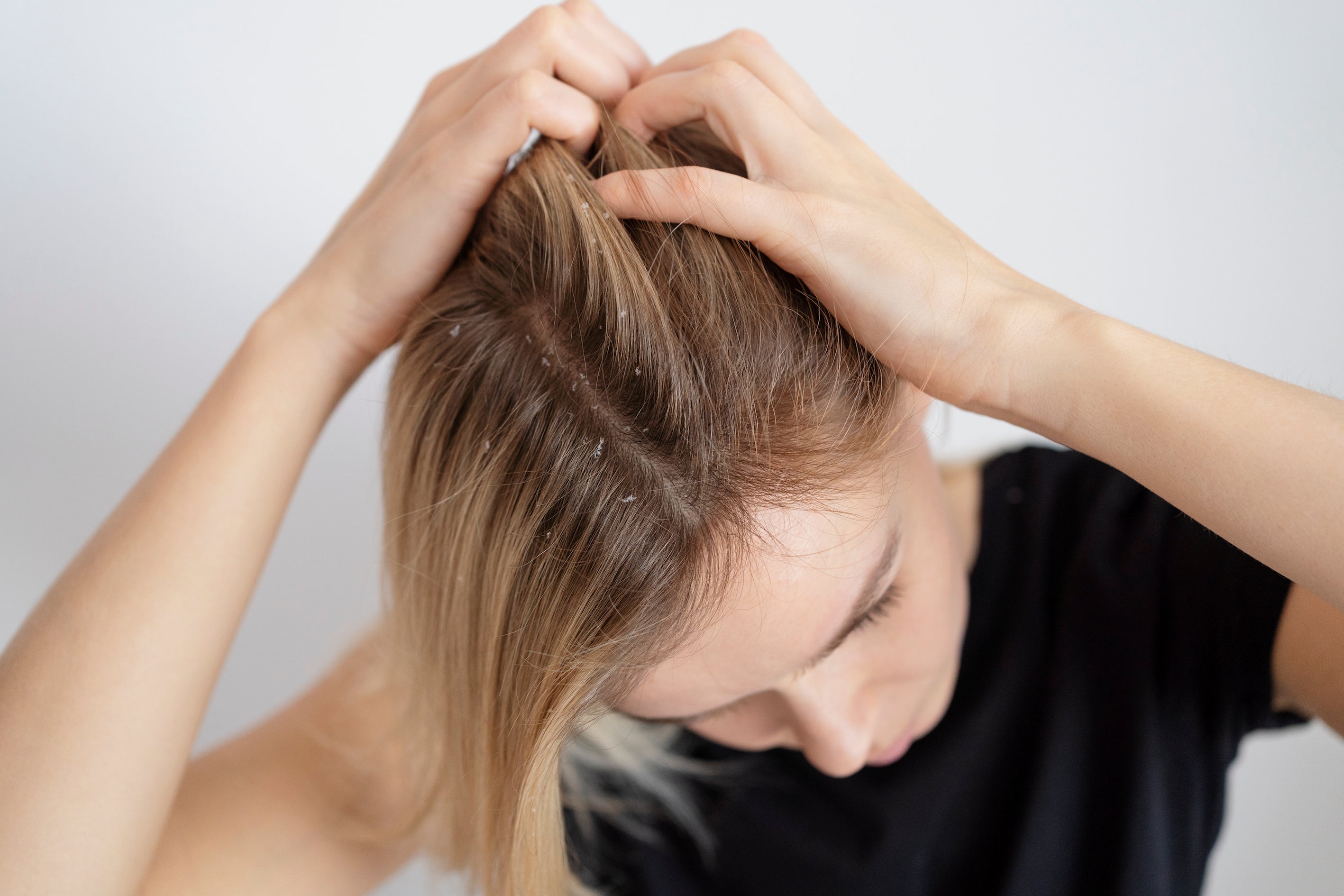 A queda do cabelo e a dermatite seborreica: tem relação?