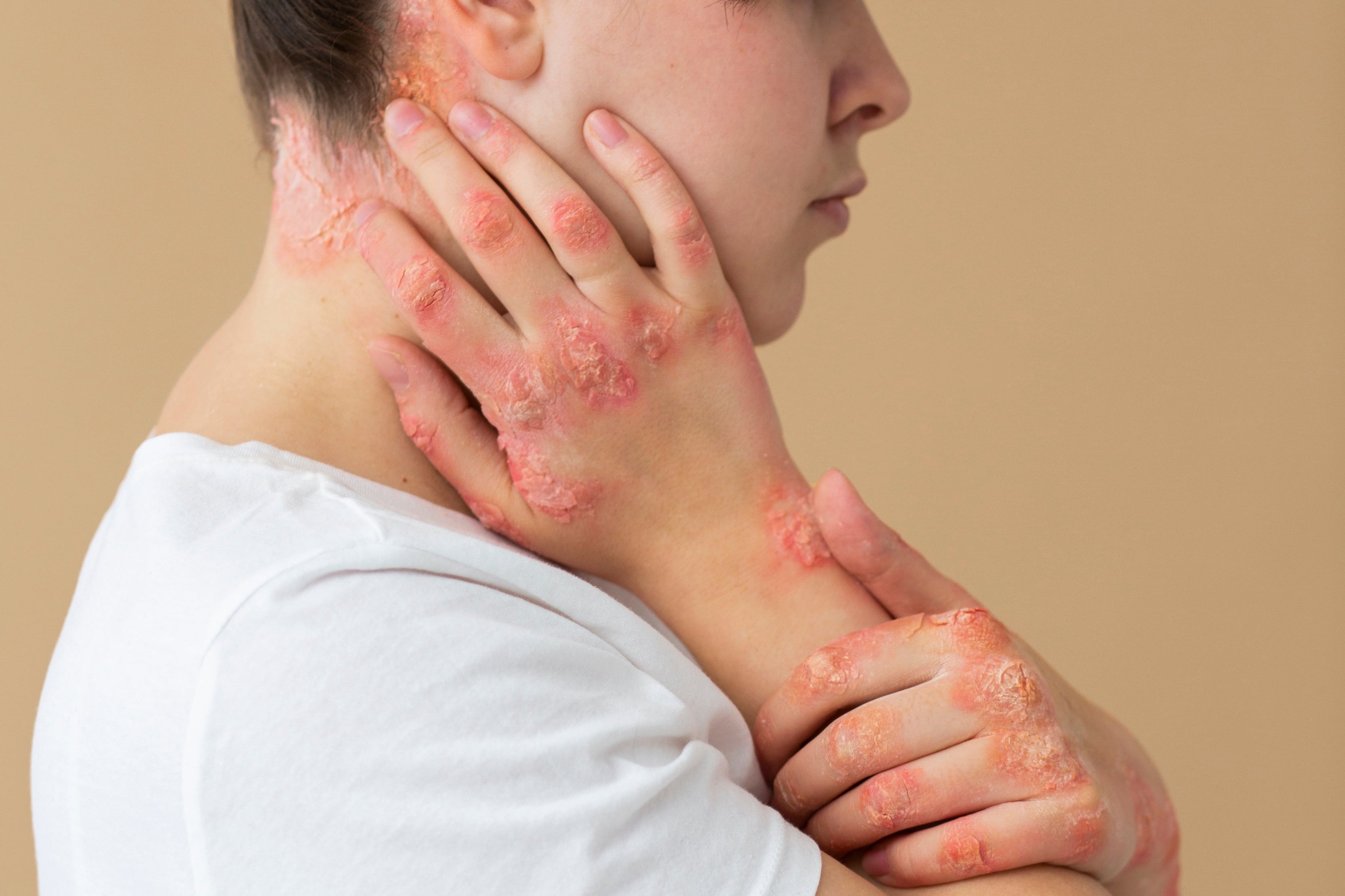 Dermatite Atópica e Psoríase: Como os Produtos Naturais Podem Ajudar