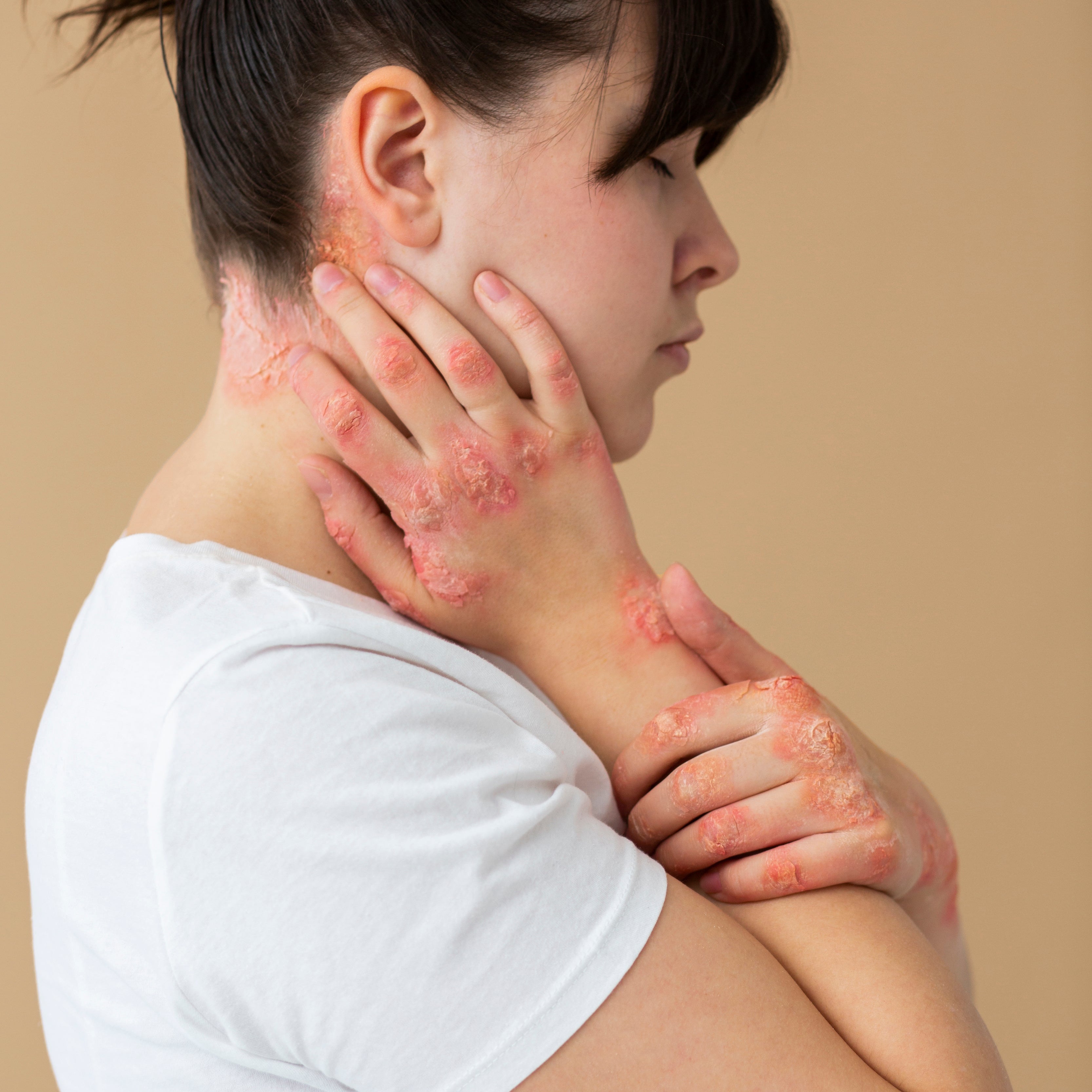 Dermatite Atópica e Psoríase: Como os Produtos Naturais Podem Ajudar